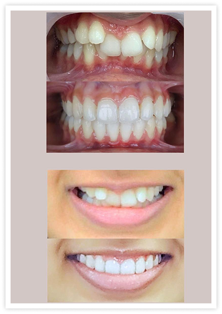 tooth1