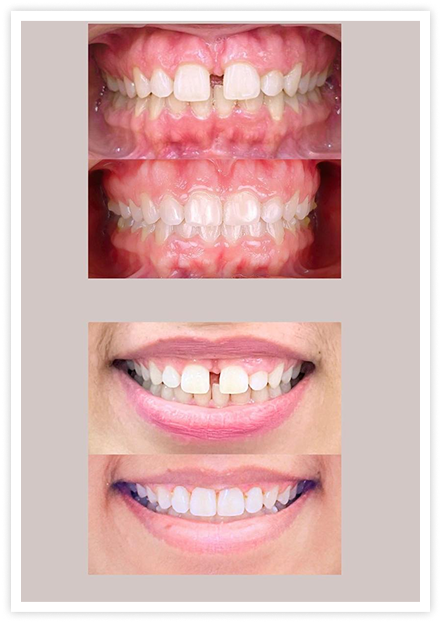 tooth2