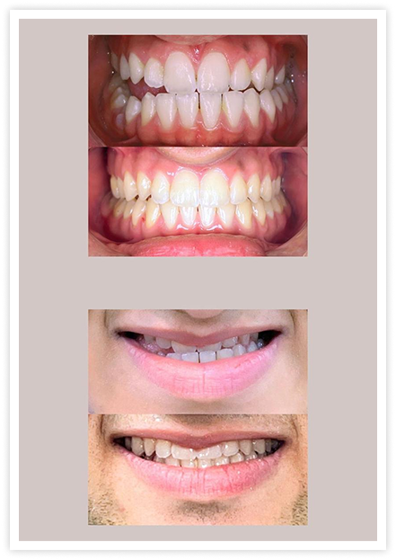 tooth3