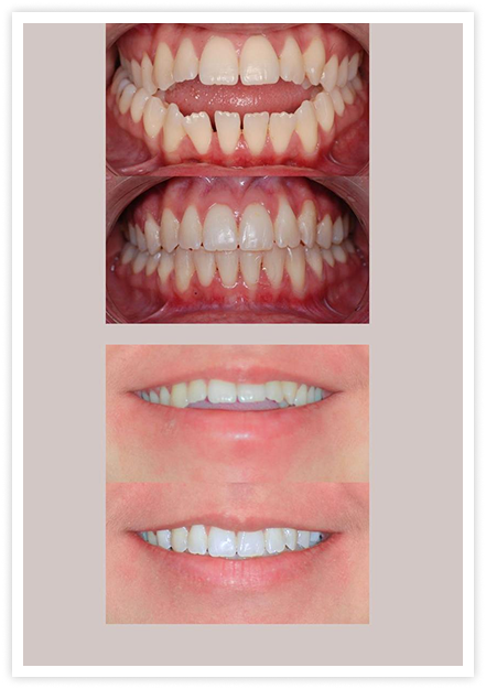 tooth4