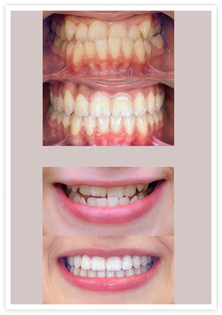 tooth6